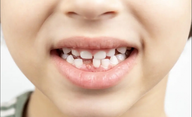 Çocuklarda Diş Sağlığı Nasıl Olmalı?